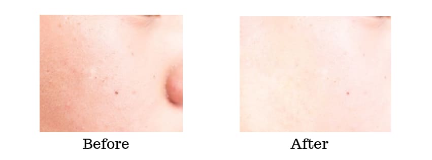 ミレム　ビュートリックの使用前と使用後